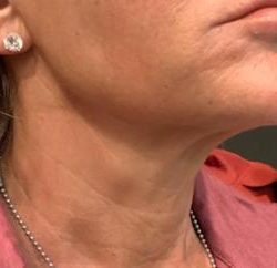 Sofwave Before & After Patient #1602